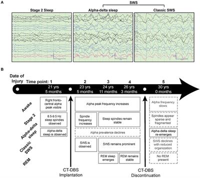 Daytime Central Thalamic Deep Brain Stimulation Modulates Sleep Dynamics in the Severely Injured Brain: Mechanistic Insights and a Novel Framework for Alpha-Delta Sleep Generation